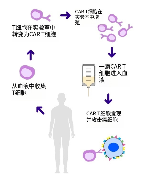 惊爆！92%患者肿瘤缩小或消失，CAR-T细胞免疫疗法让癌症患者重燃希望
